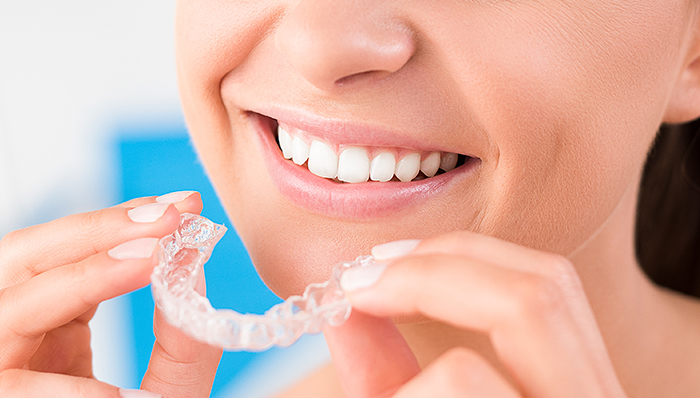 Invisalign vs Veneers