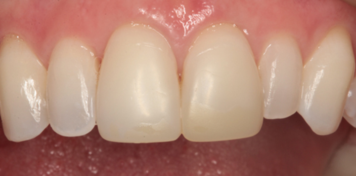 Composite Veneers