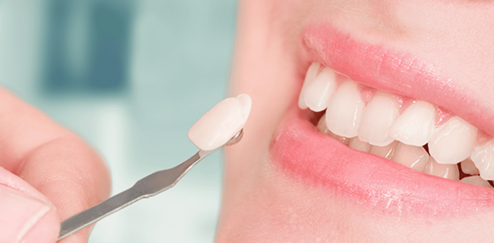 How Porcelain Veneers Are Changing Lives