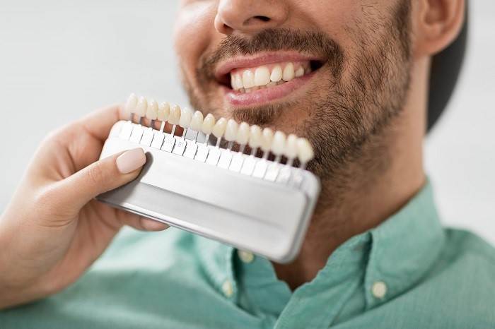 FAQ: Composite Veneers – All Your Questions Answered