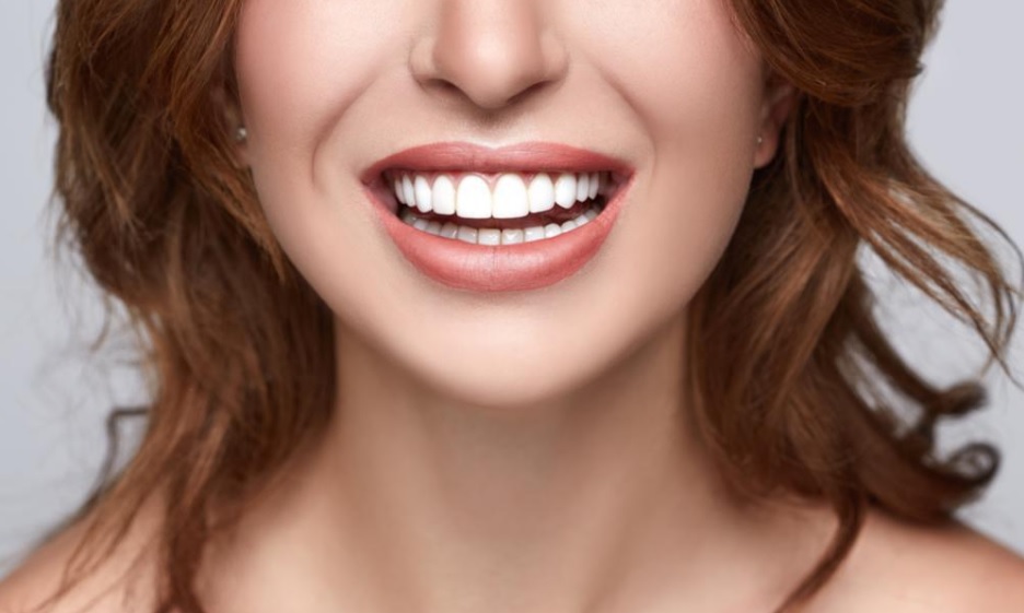 Porcelain Veneers