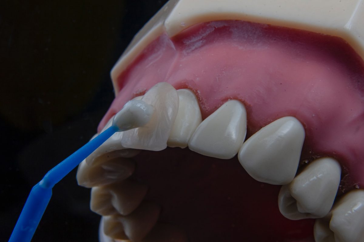 Achieving a Seamless Smile: Do Natural-Looking Veneers Look Like Your Own Teeth?