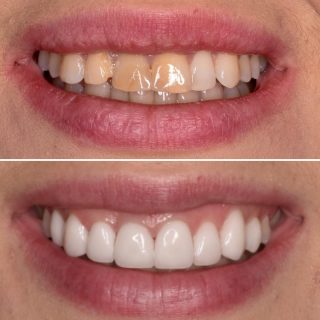 Did you know Veneers can whiten your smile by covering discounted teeth? 

Book your free veneer consultation by emailing or calling us. 
info@kennedydentalcosmetics.com.au 
0293318114

#veneers #sydneyveneers #sydneyteeth #porcelainveneers #porcelainveneerssydney #cosmeticdentistry #cosmeticdentist #sydneydentist #teeth #hollywoodsmile #smile #whiteteeth