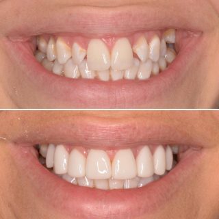 Peg laterals are very common and easily fixed with veneers 

8 Veneers for $7,999 including a free veneer consultation 

Book now through email info@kennedydentalcosmetics.com.au  or call us on 0293318114 

#veneers #dentalveneers #porcelainveneers #porcelainveneerssydney #sydneyveneers #dentist #cosmeticdentistry #teeth #hollywoodsmile #smile