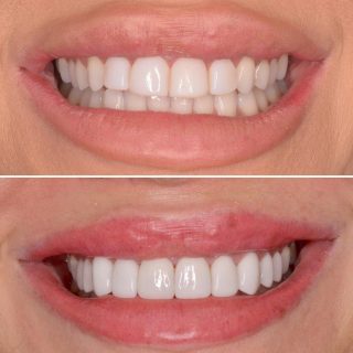 Composite Bonding vs Porcelain Veneers 

Removing composite veneers and changing them to porcelain veneers ??
Results show for themselves 

Free veneer consultation, 
To book in call us on 0293318114 or email us at info@kennedydentalcosmetics.com.au

BL1LT
#sydneyveneers #sydneydentist #sydneydentalveneers #porcelainveneers #sydneyporcelainveneers #cosmeticdentistry #cosmeticdentist #cosmeticdentistsydney #porcelainveneers #teeth #teethgoals #whitesmile #smilemakeover #hollywoodsmile