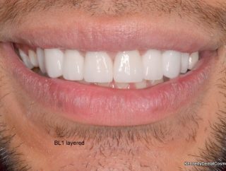 The Perfect smile 

BL1  Layered 

#cosmeticdentistry #cosmeticdentistsydney #hollywoodsmile #smile #teethgoals #porcelainveneers #veneers #dentalveneers #porcelainveneerssydney #crownssydney #dentalcrowns #whiteteeth #teeth #dentalveneers