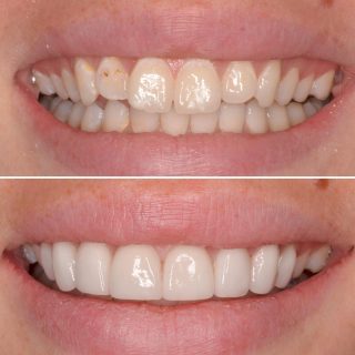 Porcelain Veneers ???? 

#porcelainveneers #dentalveneers #dentist #dentistry #cosmeticdentistry #cosmeticveneers #porcelainveneerssydney #sydneyveneers #sydneycosmeticdentist #sydneydentist #veneers #emaxveneers #smile #beforeandafter #hollywoodsmile #whiteteeth #teeth