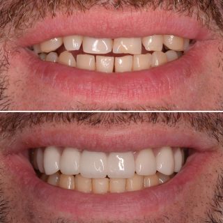 This patient had been missing a front tooth from a football accident years ago. 

After wearing a partial denture for many years he decided it was time for a change. 

(An implant was not a fesable option right now) 

We made a bridge for missing tooth at the front and veneered the other teeth to give him a fuller, whiter more confident smile. 

BL3 

#cosmeticdentistry #teethbridge #emaxveneers #porcelainveneers #veneers #dentalveneers #dental #dentistry #dentalbridge #dentalbridgesydney #sydneyveneers #veneerssydney #teeth #sydneyteeth #sydneydentist