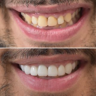 Another amazing result using veneers 

#porcelainveneers #veneers #dentalveneers #veneers #teeth #sydneyveneers #sydneycosmeticdentist #sydneyporcelainveneers #whiteteeth #smile #smilemakeover