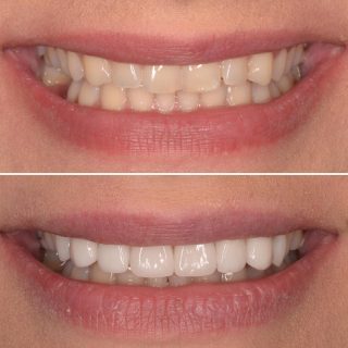 Subtle changes using 8 porcelain veneers ✨

BL2 
#sydneyveneers #sydneyteeth #sydneyporcelainveneers #dentalveneers #porcelainveneers #veneers #cosmeticdentistry #cosmeticdentistsydney #emaxveneers #sydneydentist