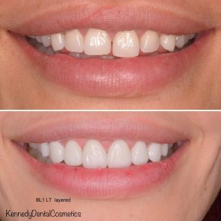 Goal Achieved ☑️

Whiter, straight, no gaps achieved with 8 porcelain veneers ????

Call or email us to book in your free veneer consultation 0293318114 / info@kennedydentalcosmetics.com.au 

BL1 LT Layered 

#sydneyveneers #veneers #dentalveneers #dental #porcelainveneers #emaxveneers #teeth #sydneyteeth #sydneycosmeticdentist #veneerssydney #smile #hollywoodsmile