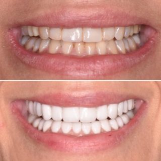 Upper and Lower Porcelain Veneers 

#veneers #dentalveneers #sydneyveneers #veneersydney #porcelainveneers #porcelainveneer #sydneyporcelainveneers #emaxveneers #teeth #cosmeticdentistry #cosmeticdentist #sydneycosmeticdentist #smile #hollywoodsmile #dentalveneers #dentistry #dental