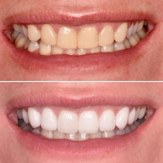 Out with the old composite and in with the new porcelain veneers ????

#porcelainveneers #veneers #dentalveneers #dentalveneerssydney #sydneyveneers #porcelainveneerssydney #sydneyteeth #sydneycosmeticdentist #teeth #smile #whitesmile #whiteteeth #teeth
