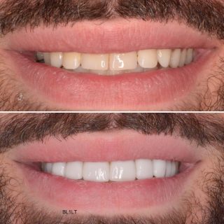 No prep veneers ????

Yes, depending on your teeth you don’t have to change the underlining tooth to get porcelain veneers. 

This patient wanted a whiter smile he couldn’t achieve with tooth whitening alone. 
He wanted a bigger smile and straight teeth. I think we aced the assignment ✨

*Note: this option isn’t for everyone but if you book in for a free consultation with Dr.Kennedy she will be able to let you know if you are a candidate for no prep veneers * 

#noprepveneers #sydneyveneers #porcelainveneers #veneers #dental #dentalveneers #sydneydentalveneers #cosmeticdentistry #cosmeticdentist #sydneycosmeticdentist #teeth #smile #hollywoodsmile