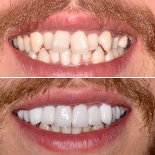 Orthodontics (braves) aren’t always the route that a patient wants to go down 

We used a mixture of crowns and veneers to achieve this look.

#veneers #dentalveneers #dentalveneer #crowns #teeth #whiteteeth #sydneyveneers #veneerssydney #porcelainveneers #porcelainveneerssydney #cosmeticdentistry