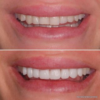 Free veneer consultations now available. Call us on 0293318114 or email us at info@kennedydentalcosmetics.com.au 

BL1 natural

#whitesmile #smilemakeover #sydneyporcelainveneers #sydneyveneers #cosmeticsdentistry #cosmeticdentist #sydneycosmeticdentist #hollywoodsmile #teeth #dentalveneers #porcelainveneers