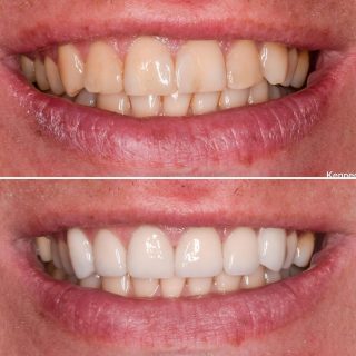 Natural veneer look ✨

Toothwhitening on Lowers & 
B1 Natural veneers used 

#veneerssydney #veneers #sydneyveneers #porcelainveneers #toothwhitening #tooth #cosmeticdentistry #dentist #dentalveneers