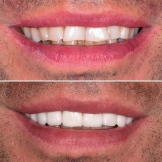 Here we used 10 Porcelain Veneers to create a wider, straight, white smile ???? 

BL1 LT 
#porcelainveneers #veneers #veneers_smile #dentalveneers #porcelainveneersydney #veneerssydney #dentalveneerssydney #cosmeticdentistry #cosmeticdentistsydney #dentistry #dentist #sydneydentist #dentalveneers
